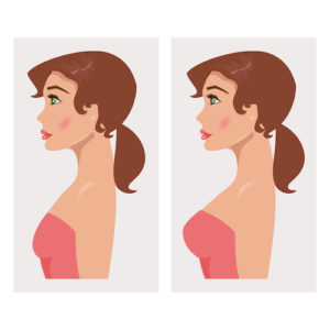 Illustration of a woman with breast before and after mammoplasty